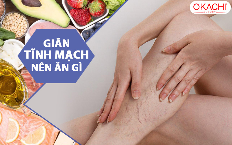 Giãn tĩnh mạch nên ăn gì để trợ giúp HỒI PHỤC nhanh chóng