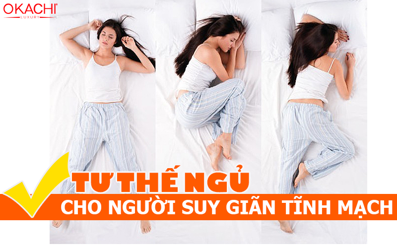 Tư thế ngủ cho người suy giãn tĩnh mạch KHỎE HƠN mỗi ngày