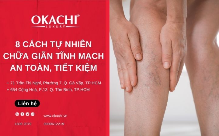 8 cách tự nhiên chữa giãn tĩnh mạch AN TOÀN, TIẾT KIỆM
