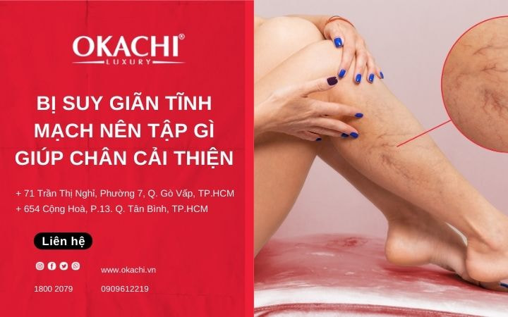 Bị suy giãn tĩnh mạch nên tập gì giúp chân cải thiện