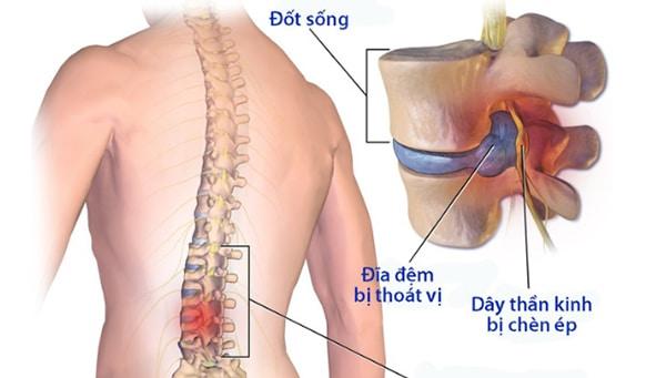 thoát vị đế đệm chèn ép dây thần kinh