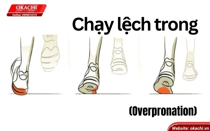 Chạy lệch trong (Overpronation)