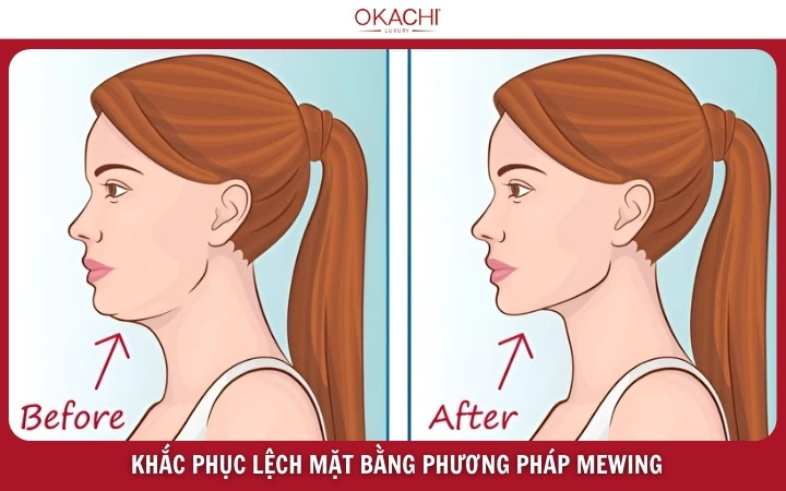 khac phuc lech mat bang phuong phap mewing