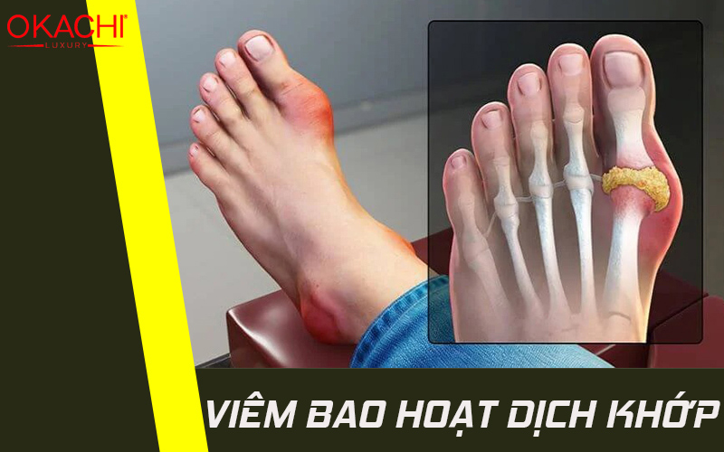 Viêm bao hoạt dịch khớp