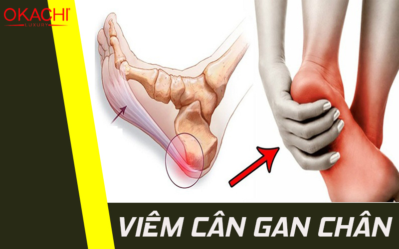 Viêm cân gan chân