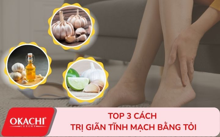 Top 3 cách trị giãn tĩnh mạch bằng tỏi nhanh nhất