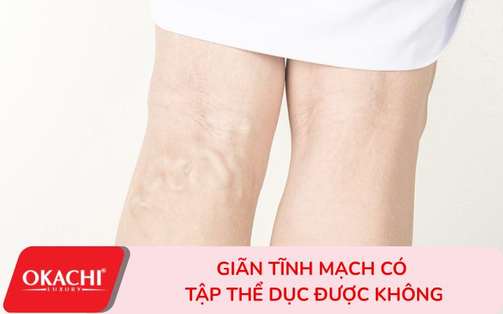 Giãn tĩnh mạch có tập thể dục được không