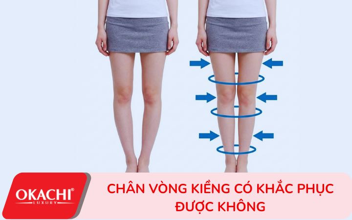Chân vòng kiềng có khắc phục được không