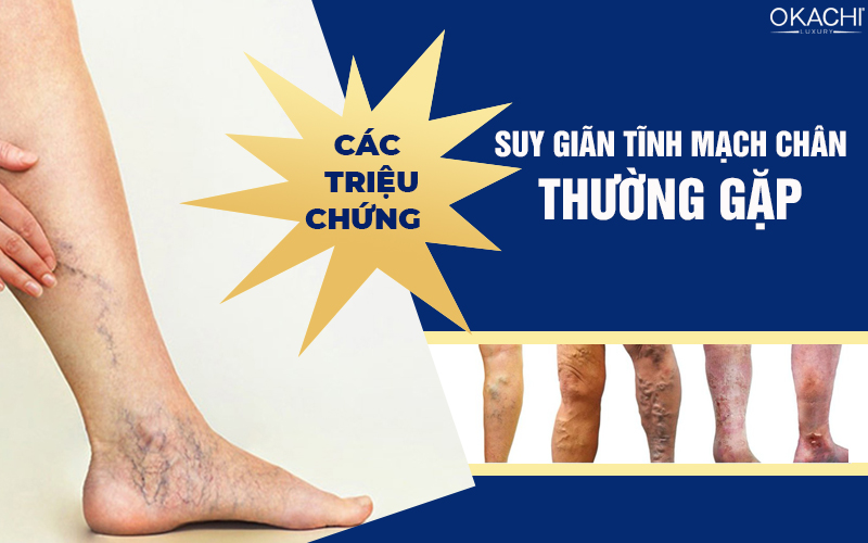 Các triệu chứng suy giãn tĩnh mạch chân thường gặp