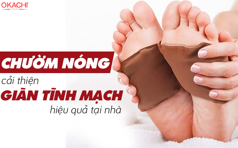 Chườm nóng cải thiện giãn tĩnh mạch hiệu quả tại nhà