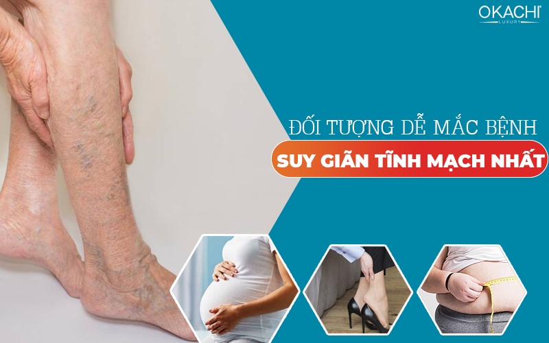Đối tượng dễ mắc bệnh suy giãn tĩnh mạch nhất