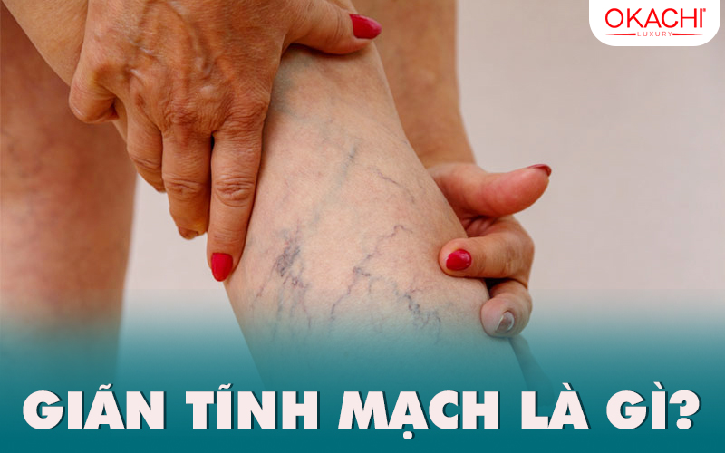 Giãn tĩnh mạch là gì?