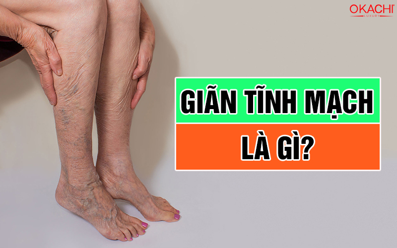Giãn tĩnh mạch là gì?