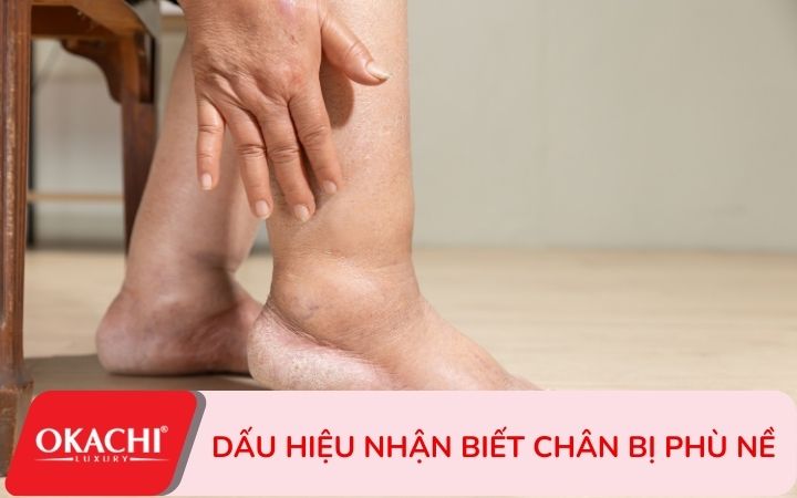 dấu hiệu nhận biết chân bị sưng phù nề