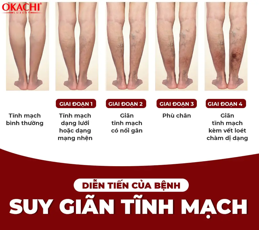 Máy nén ép TRỊ LIỆU suy giãn tĩnh mạch Okachi luxury JP-3000 Plus pin sạc