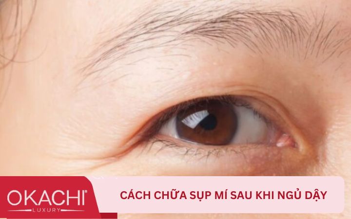 Cách chữa sụp mí sau khi ngủ dậy