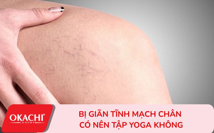 Bị giãn tĩnh mạch chân có nên tập yoga không