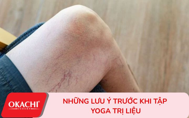 Những lưu ý quan trọng trước khi tập yoga cho người suy giãn tĩnh mạch