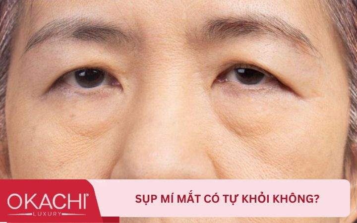 Sụp mí mắt có tự khỏi không