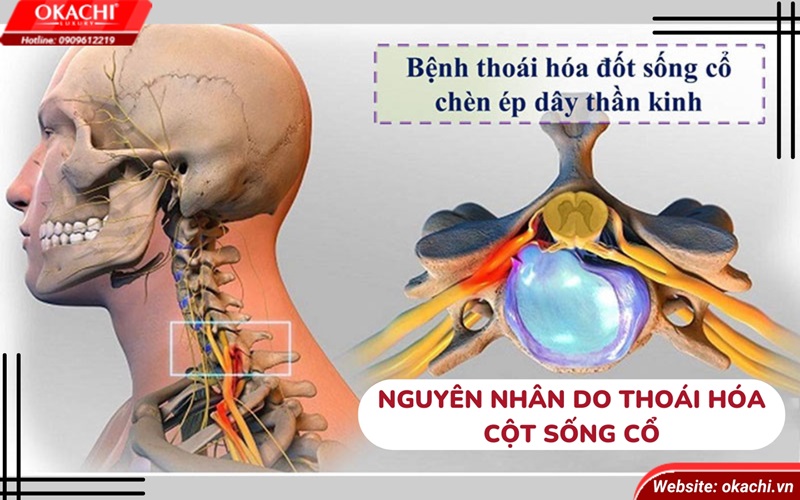 nguyên nhân do thoái hóa cột sống cổ