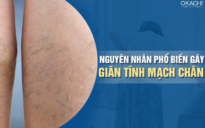 Nguyên nhân phổ biến gây giãn tĩnh mạch chân 