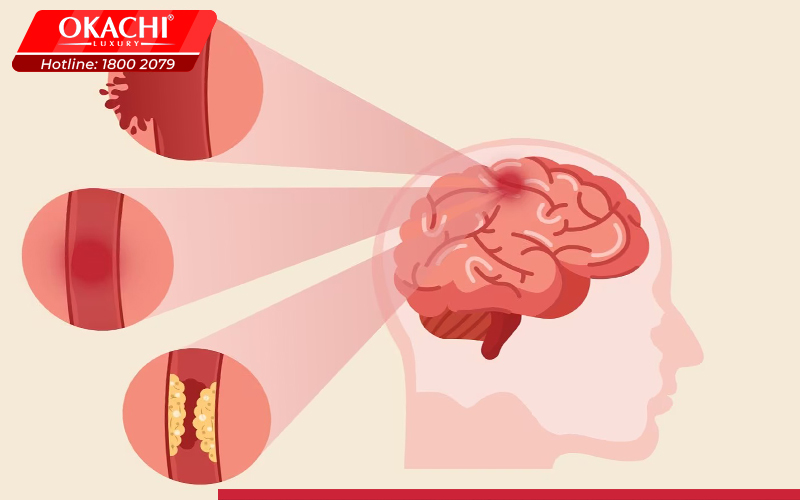 Phòng ngừa các triệu chứng đột quỵ