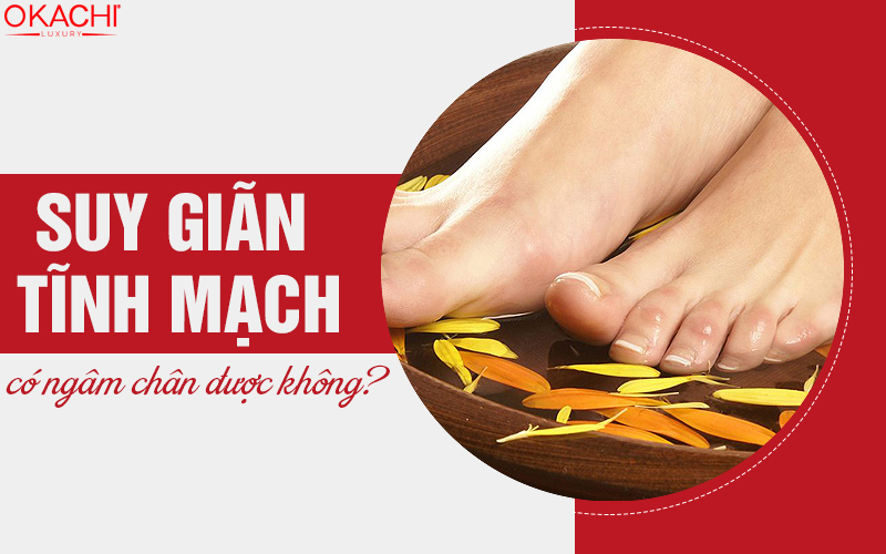 Suy giãn tĩnh mạch có ngâm chân được không