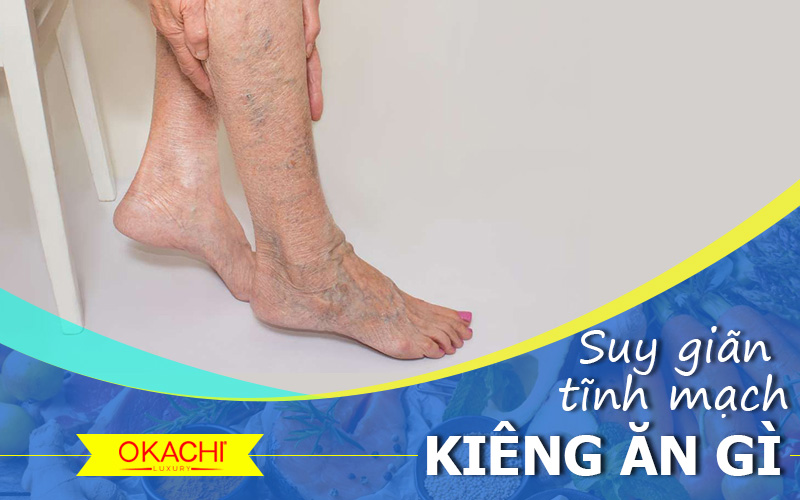 Suy giãn tĩnh mạch kiêng ăn gì