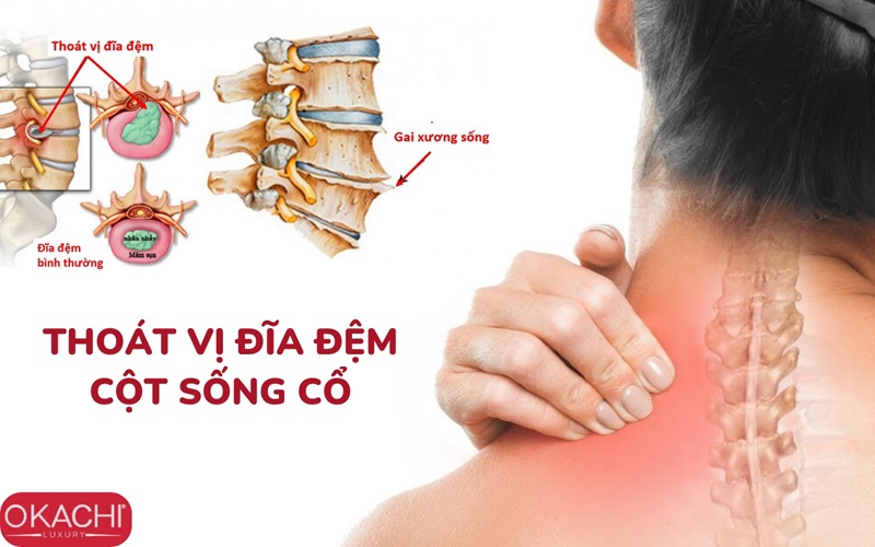 Thoát vị đĩa đệm cột sống cổ là nguyên nhân bị đau cổ vai gáy khi ngủ dậy