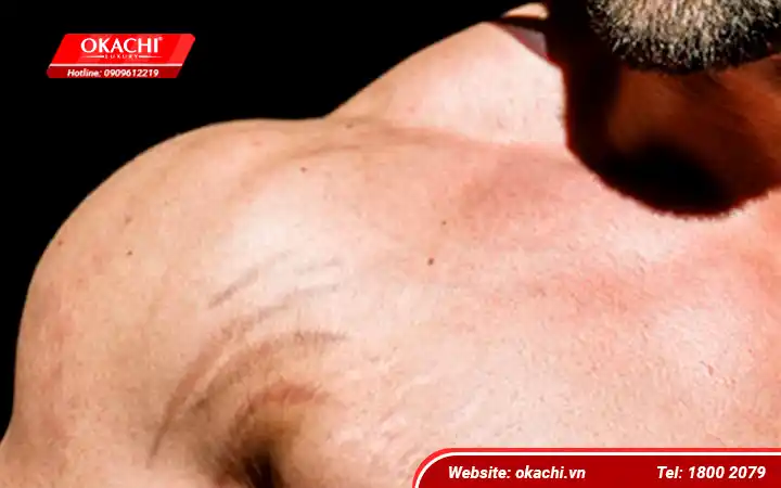 Rạn cơ vai khi tập Gym