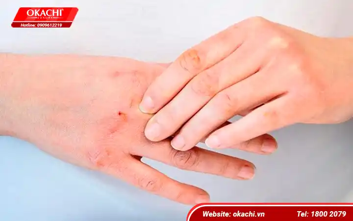 Người mắc bệnh về da không nên bơi lội 