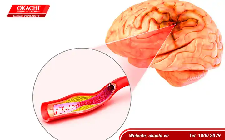 Mất cơ là gì?