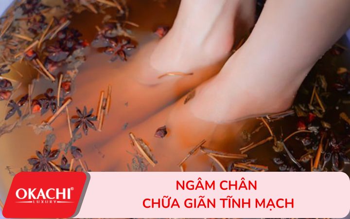 Giãn tĩnh mạch nên ngâm chân với gì