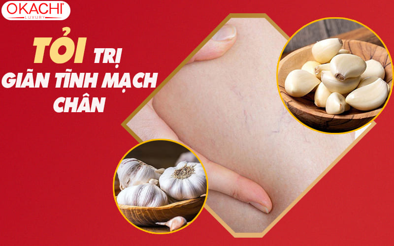 tỏi trị suy giãn tĩnh mạch chân