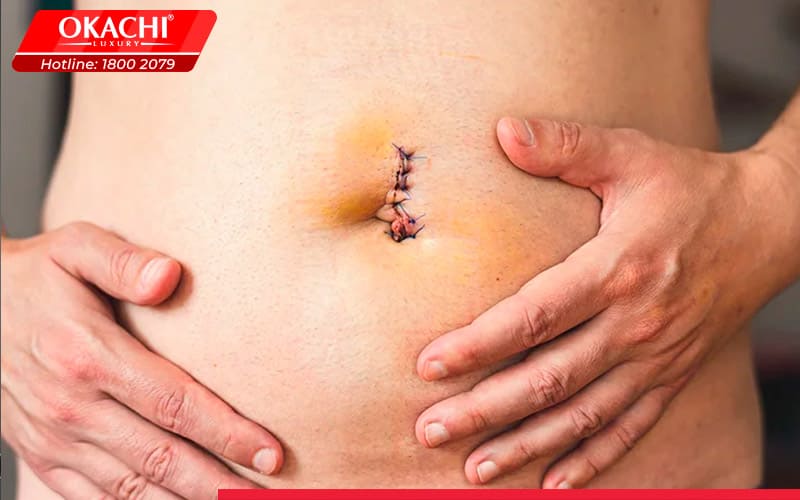 Tránh dùng khi có vết thương hở ở bụng